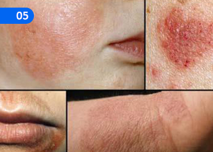 Prevent Diseases caused by Microbes and Parasites,ක්ෂුද්‍ර ජීවීන්ගේ හා පාරිතෝෂිතයන්ගෙන් වැලදෙන රෝග වලක්වා ගනිමු,Grade 4 Health & Physical Education Lessons ,Grade 4 Health & Physical Education Paadam